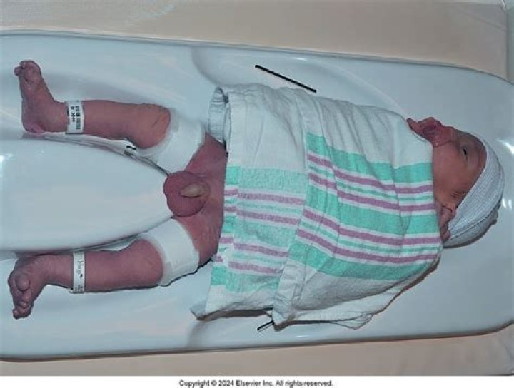 Are babies numbed when circumcised?