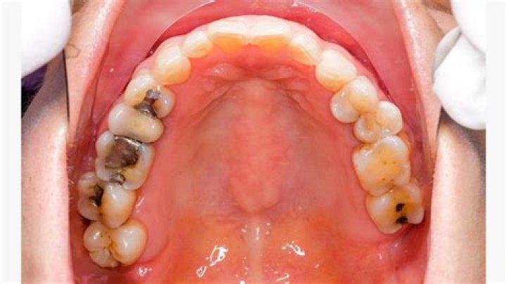 Are cavity fillings black?