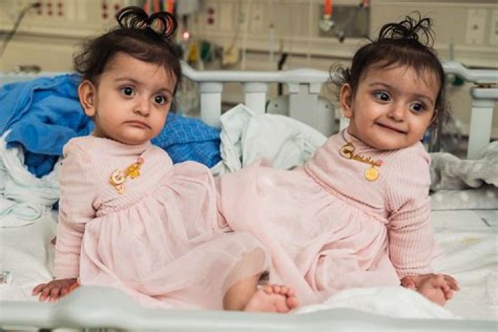 Are conjoined twins chimeras?