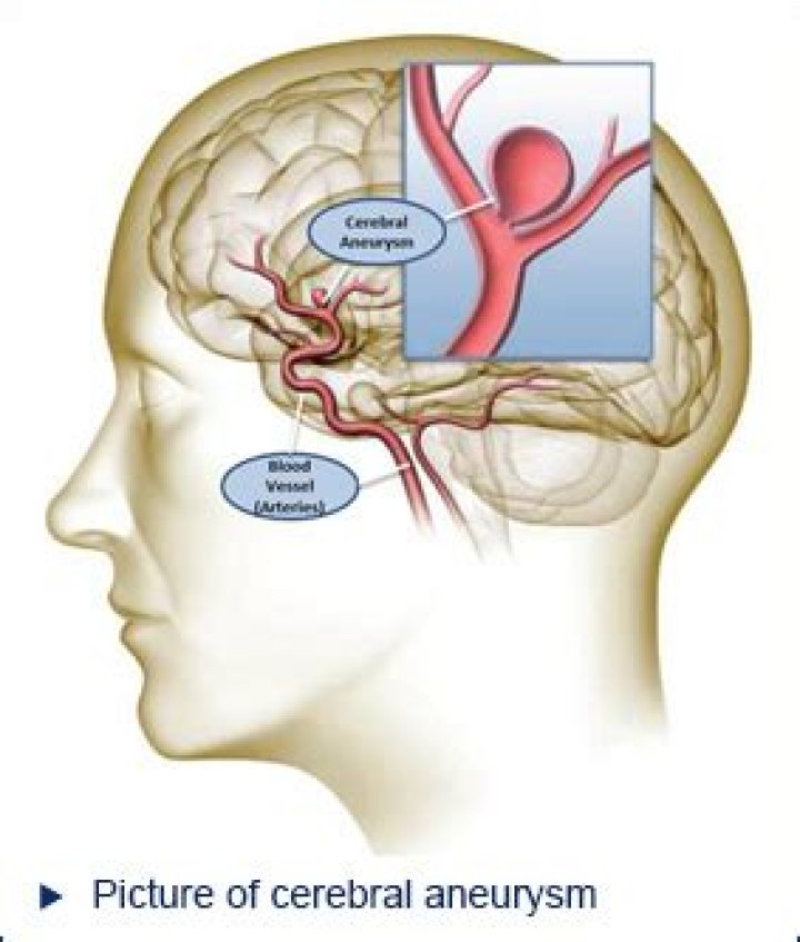 Are ruptured brain aneurysms painful?