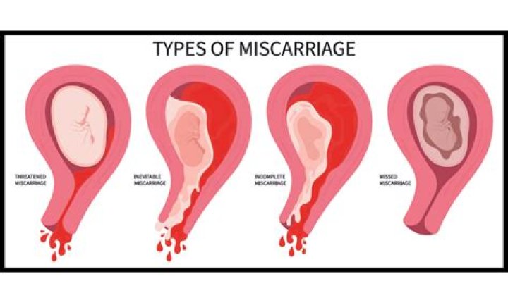 Can long journey cause miscarriage?