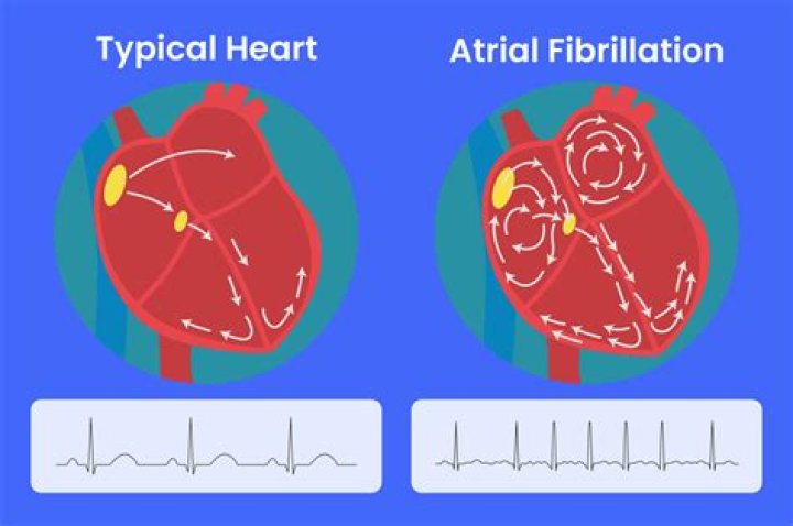 Can stress cause afib?