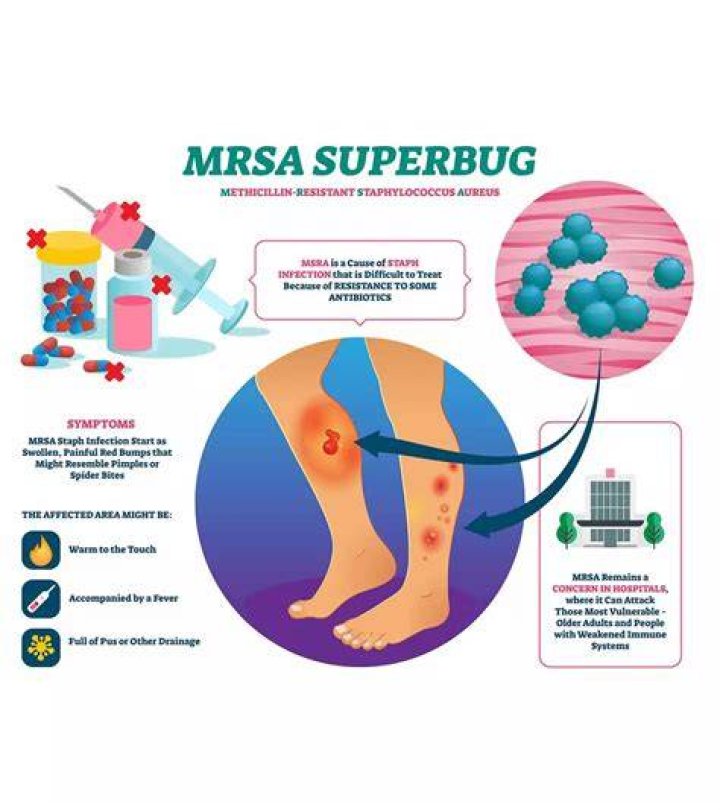 Can you get rid of mrsa colonization?