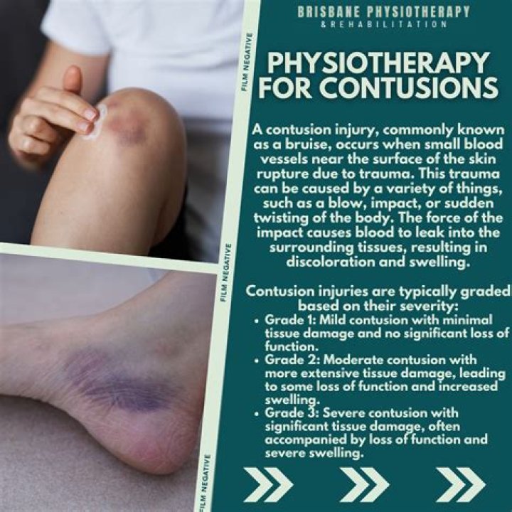 Can you massage a contusion?