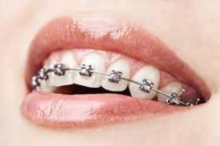Can you wear braces twice?
