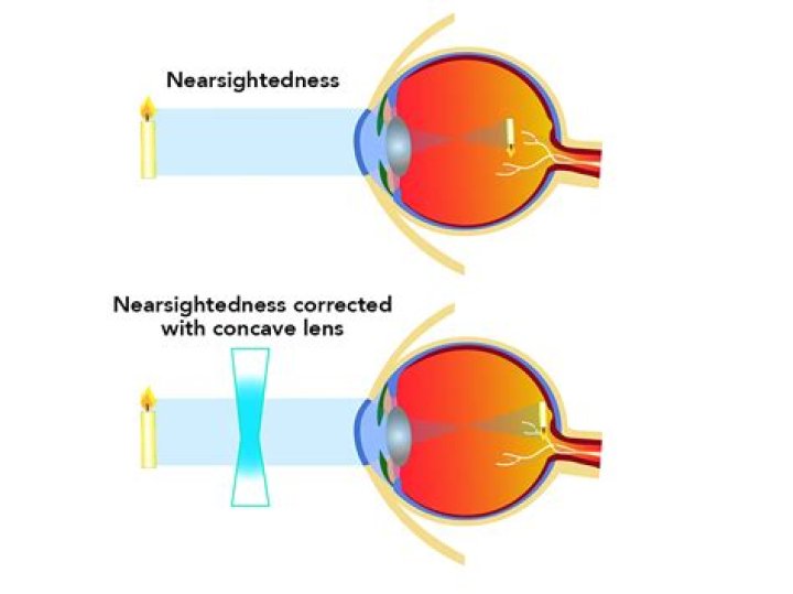 Do nearsighted need glasses?