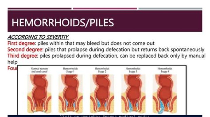 Do piles always bleed?