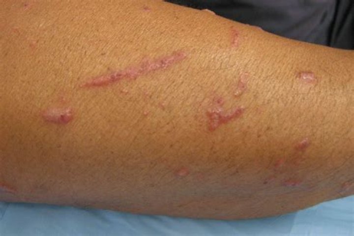 Do sumac trees cause allergies?