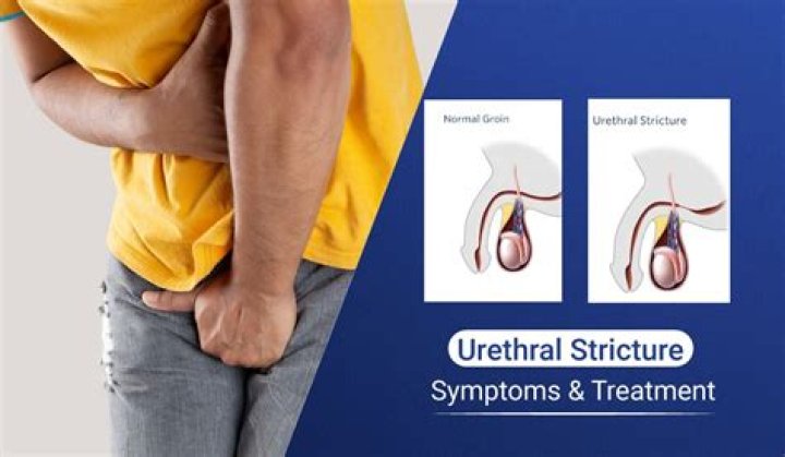 Do urethral strictures bleed?