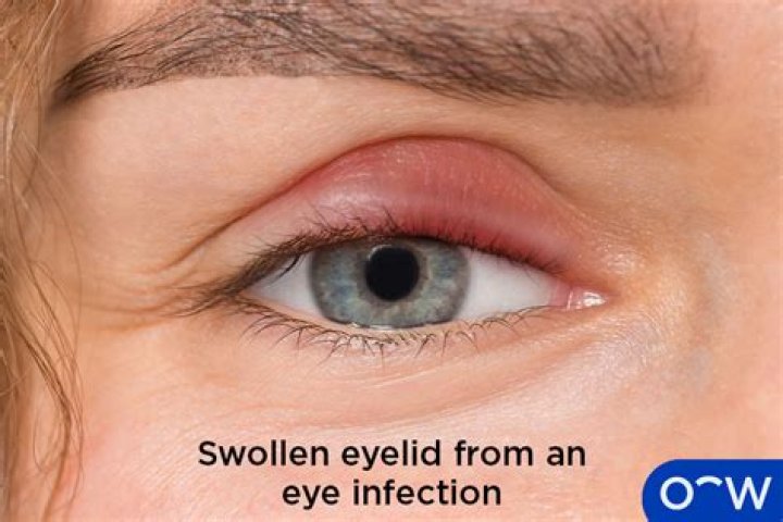 Does a stye cause gunk?