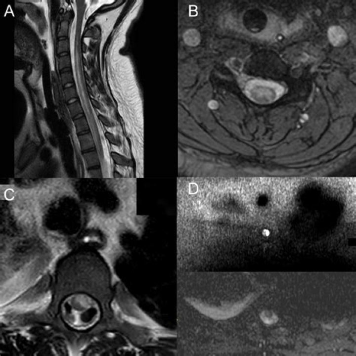 Does fibrocartilaginous embolism hurt?