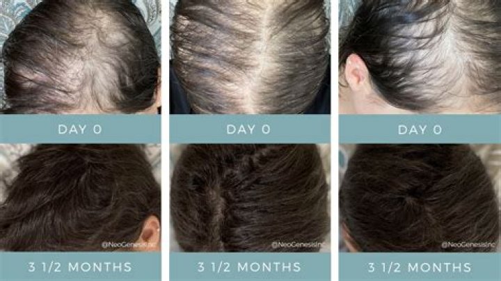 Does oxandrolone cause hair loss?