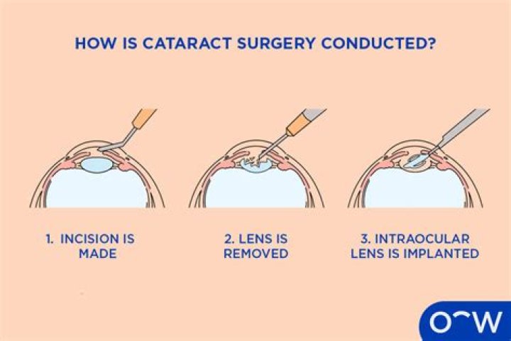 Has cataract surgery improved?