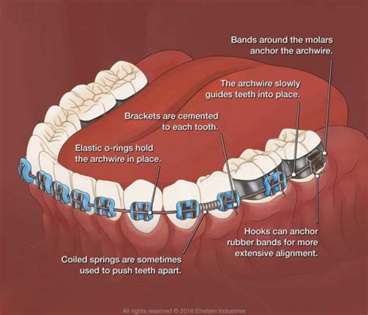 How are braces made?