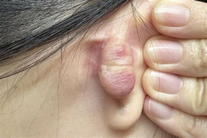 How do you know if your growing a keloid?