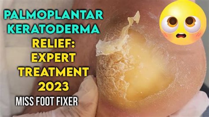 How is keratoderma treatment?
