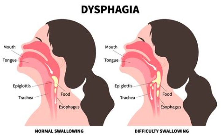 In medical terms what is a dysphagia?