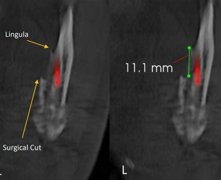In sagittal split osteotomy?