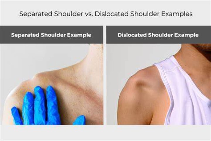 In which direction does the shoulder usually dislocate?