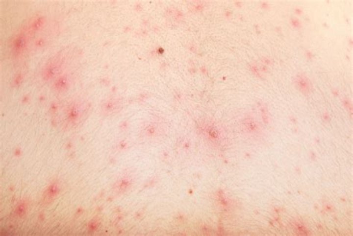 Is chickenpox a virus?
