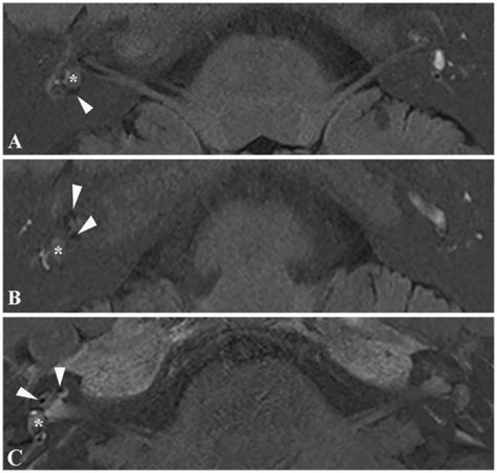 Is endolymphatic hydrops reversible?