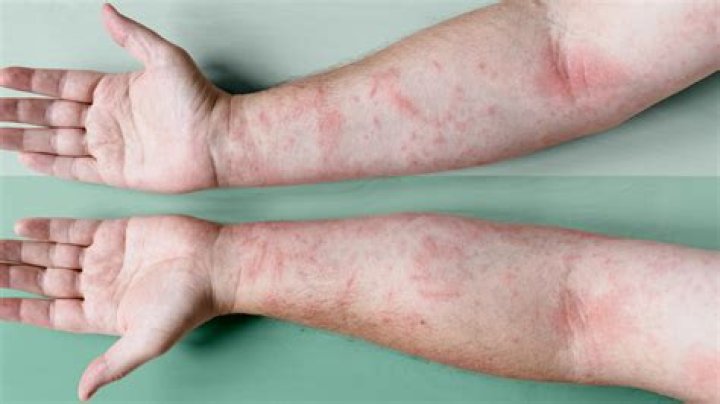 Should you freeze atopica?