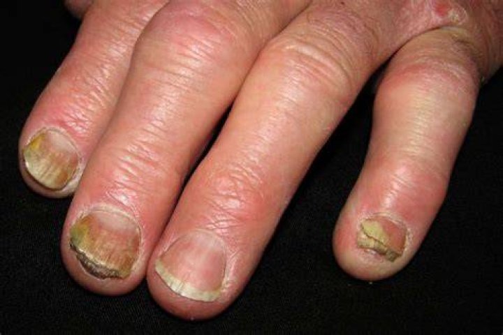 What causes breakage of nails?