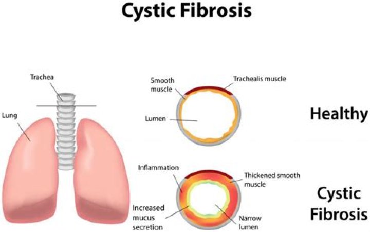 What causes cystic fibrosis?