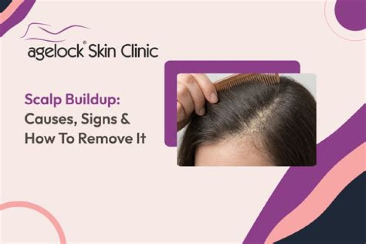 What causes skin buildup on scalp?