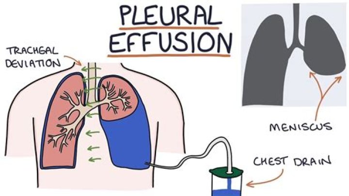 What does effusion mean?