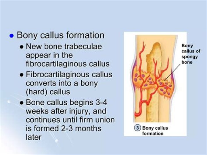 What happens in fibrocartilaginous callus formation?