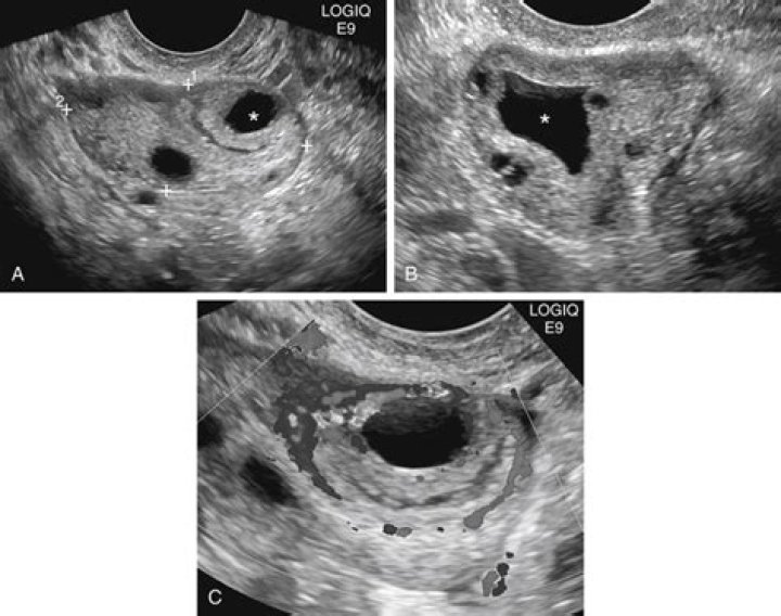 What is a crenulated cyst?
