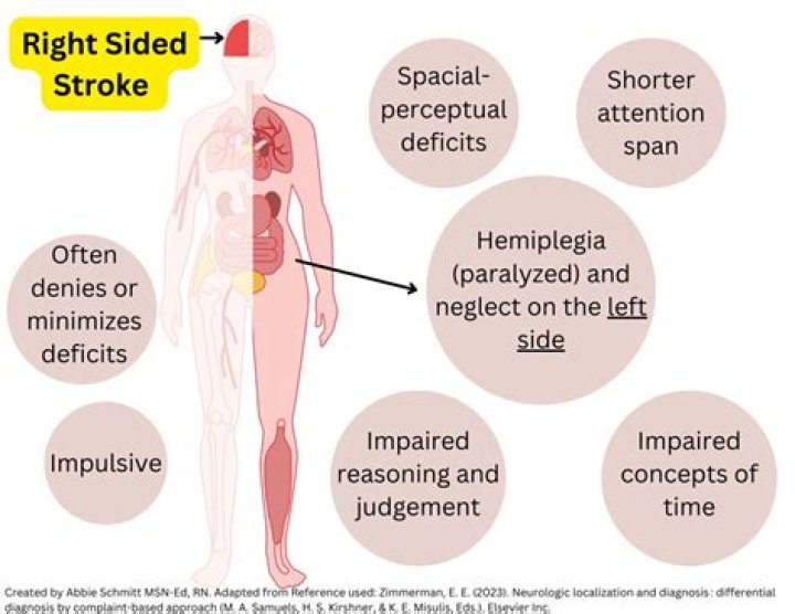 What is a right sided stroke?