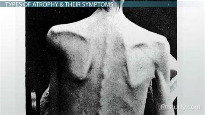 What is atropinization meaning?