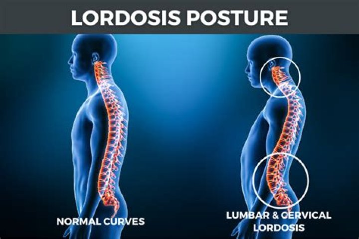 What is lordosis of the spine?
