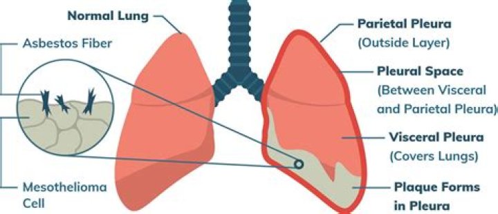 What is pleural thickening?