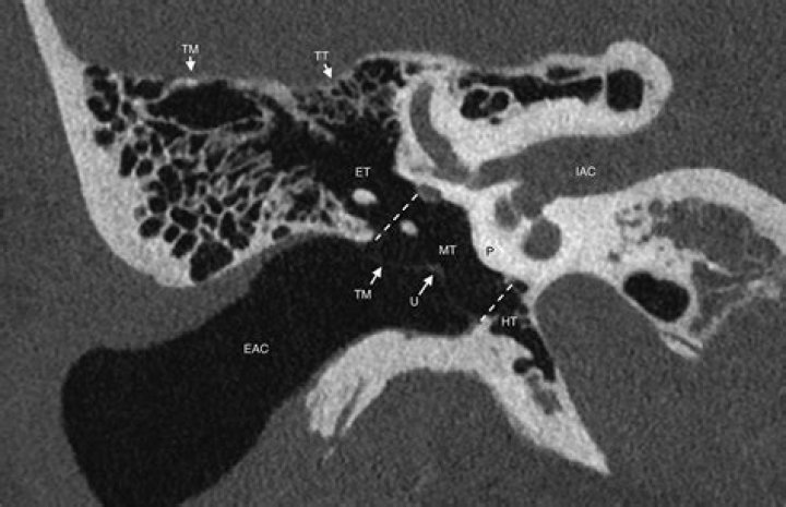 What is the relation of tegmen tympani to the middle ear?