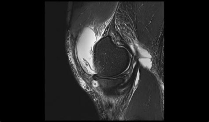 Whats a cyst rupture?