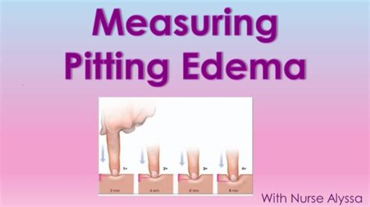 Whats a pitting oedema?