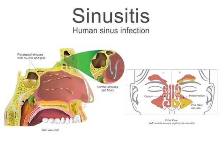 When is a sinus infection contagious?