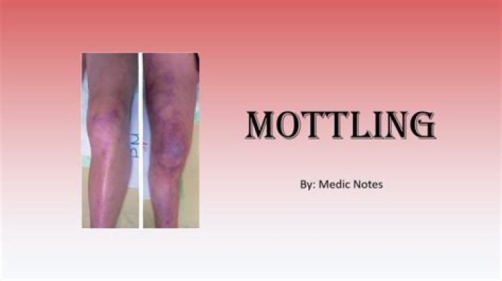Where does mottling start?