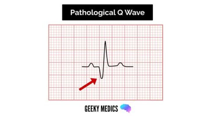 Where is the q wave?