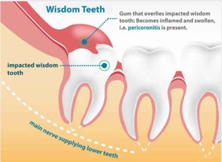 Where wisdom teeth were hurts?
