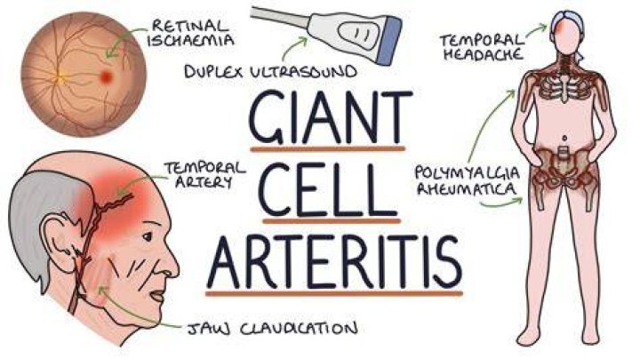 Which condition is also known as angiitis?