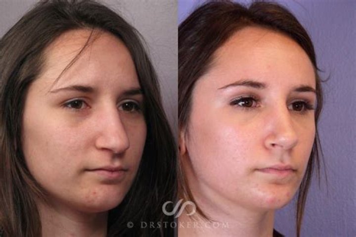 Which doctor does septoplasty?