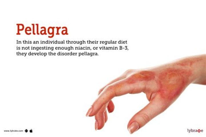 Which vitamin causes pellagra?