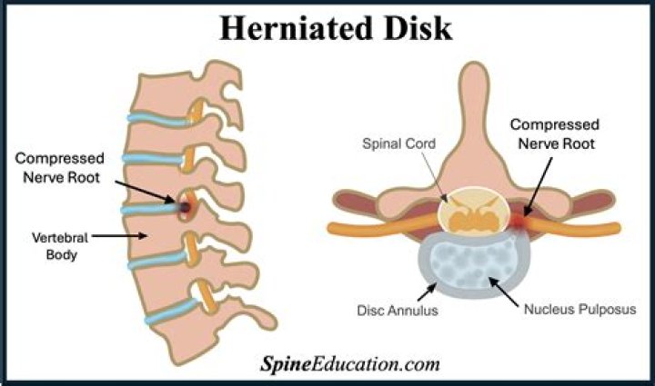 Who gets herniated disk?