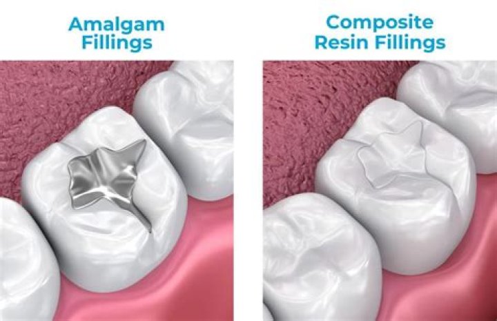 Who is composite filling?