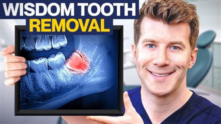 Who removes wisdom teeth?