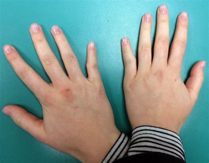 Why are my fingers crooked?